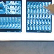 Soluzione-denti-mancanti-arcata-superiore