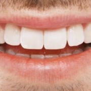 implantologia-a-carico-immediato-all-on-four-roma