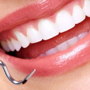 implantologia-dentale-post-estrattiva-roma