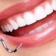 implantologia-dentale-post-estrattiva-roma