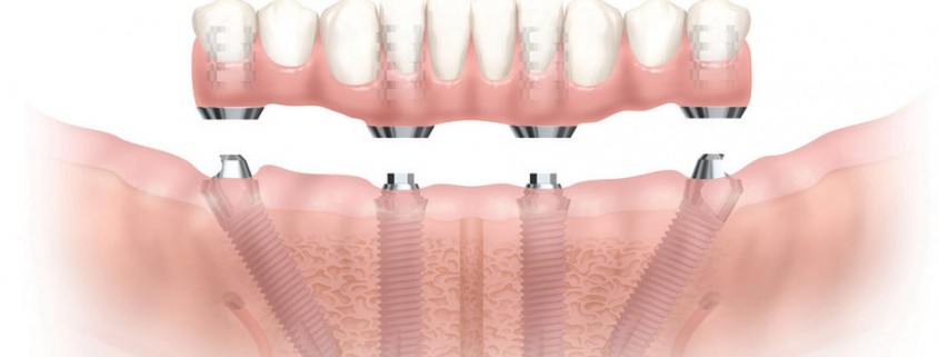impisnti-dentali-tianio-nobel-biocare-roma